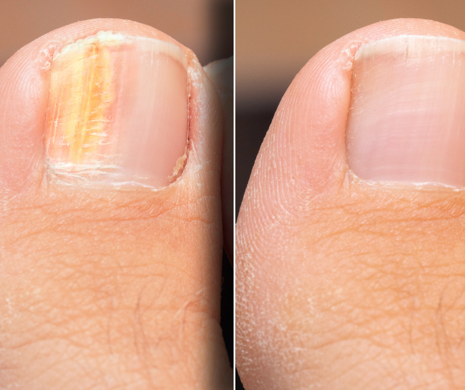 PROPOXAN - mit Mykofilm-Löser